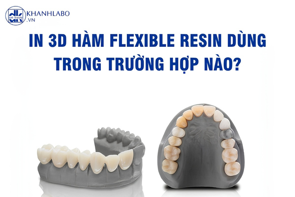 Trường hợp In 3D hàm Flexible Resin